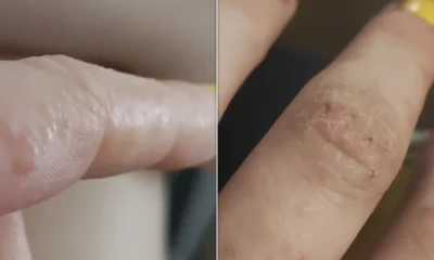 What Tiny Itchy Bumps On Your Hands And Feet Mean And How To Treat Them