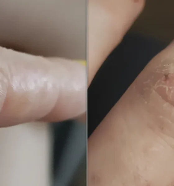 What Tiny Itchy Bumps On Your Hands And Feet Mean And How To Treat Them