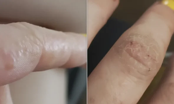 What Tiny Itchy Bumps On Your Hands And Feet Mean And How To Treat Them