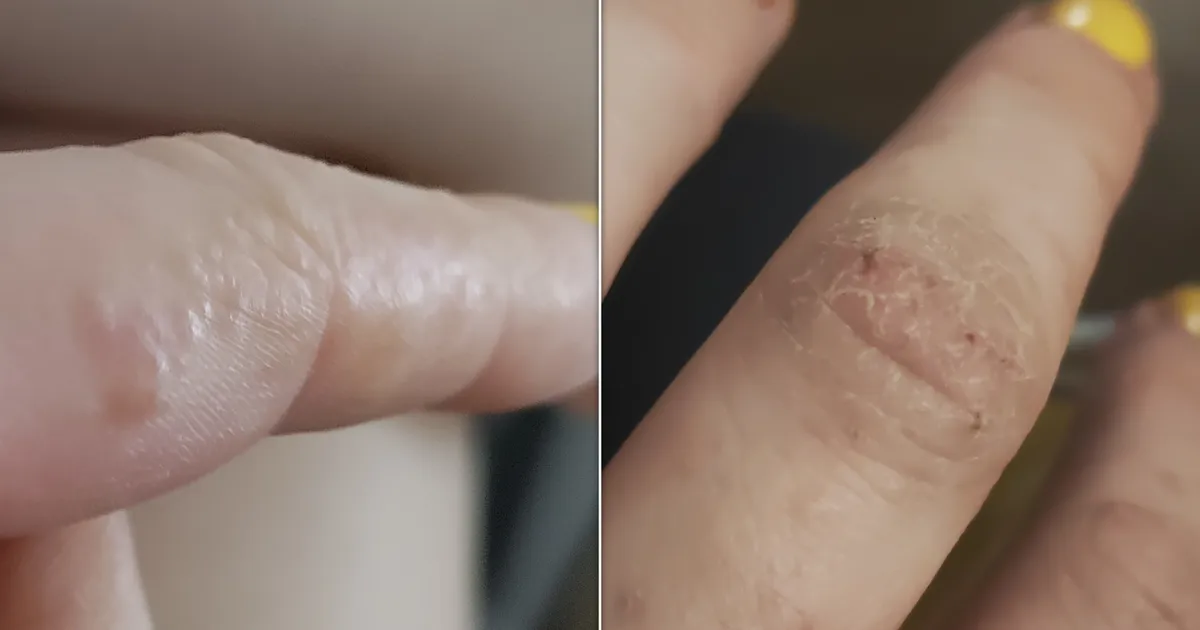 What Tiny Itchy Bumps On Your Hands And Feet Mean And How To Treat Them