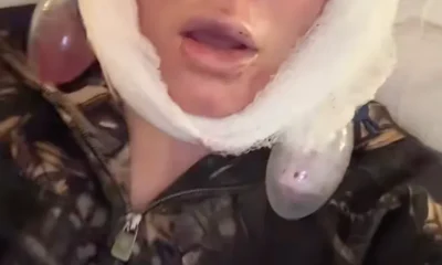 Jelly Roll's Wife Bunnie Xo Reveals Brutal Facelift Recovery