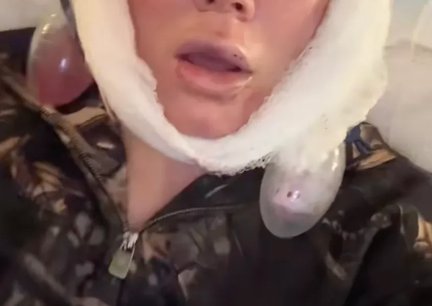 Jelly Roll's Wife Bunnie Xo Reveals Brutal Facelift Recovery