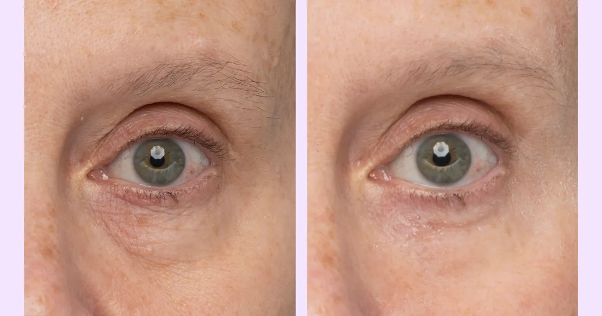 Under Eye Bags? This $30 Eye Gel Visibly Depuffs in 5 Minutes