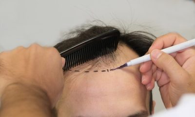 For many men in the UK, hair transplants have become the go-to solution for restoring confidence and tackling hair loss. However, the cost of a hair transplant in the UK can be daunting, often ranging between £5,000 and £15,000 depending on the clinic, technique, and number of grafts.