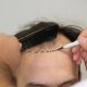 For many men in the UK, hair transplants have become the go-to solution for restoring confidence and tackling hair loss. However, the cost of a hair transplant in the UK can be daunting, often ranging between £5,000 and £15,000 depending on the clinic, technique, and number of grafts.