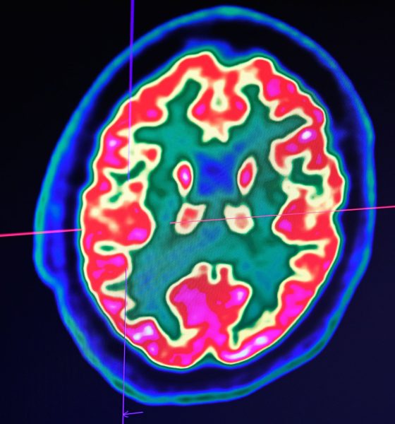The student thought it was a passing flu until diagnosis proved otherwise. In this image, a picture of a human brain taken by a positron emission tomography scanner, also called PET scan, is seen on a screen at the Regional and University Hospital Center