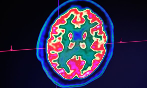 The student thought it was a passing flu until diagnosis proved otherwise. In this image, a picture of a human brain taken by a positron emission tomography scanner, also called PET scan, is seen on a screen at the Regional and University Hospital Center