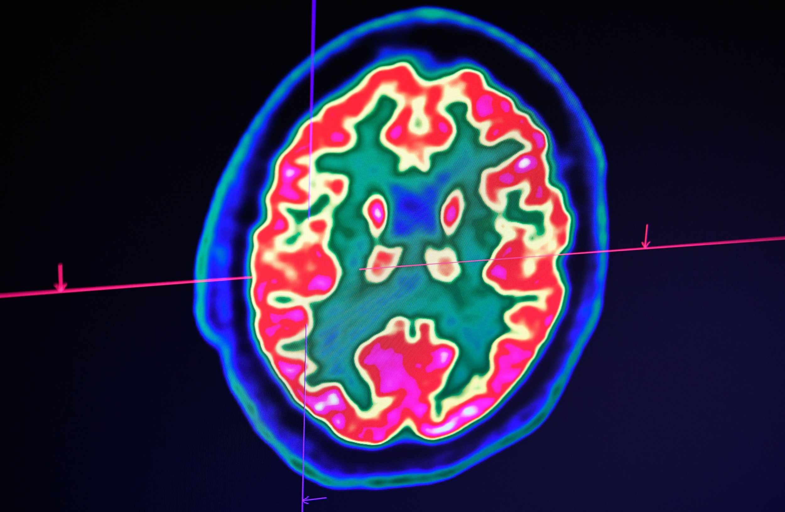 The student thought it was a passing flu until diagnosis proved otherwise. In this image, a picture of a human brain taken by a positron emission tomography scanner, also called PET scan, is seen on a screen at the Regional and University Hospital Center