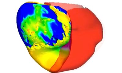 Virtual replicas of patients' hearts help doctors tackle irregular heartbeat