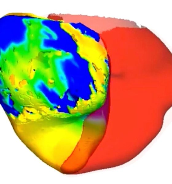 Virtual replicas of patients' hearts help doctors tackle irregular heartbeat