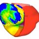 Virtual replicas of patients' hearts help doctors tackle irregular heartbeat