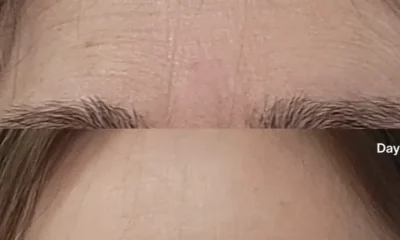 Wrinkles Between Your Brows? This 3-Minute Fix Takes Years Off