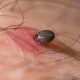 UK Health Security Agency issue tick advice to Brits