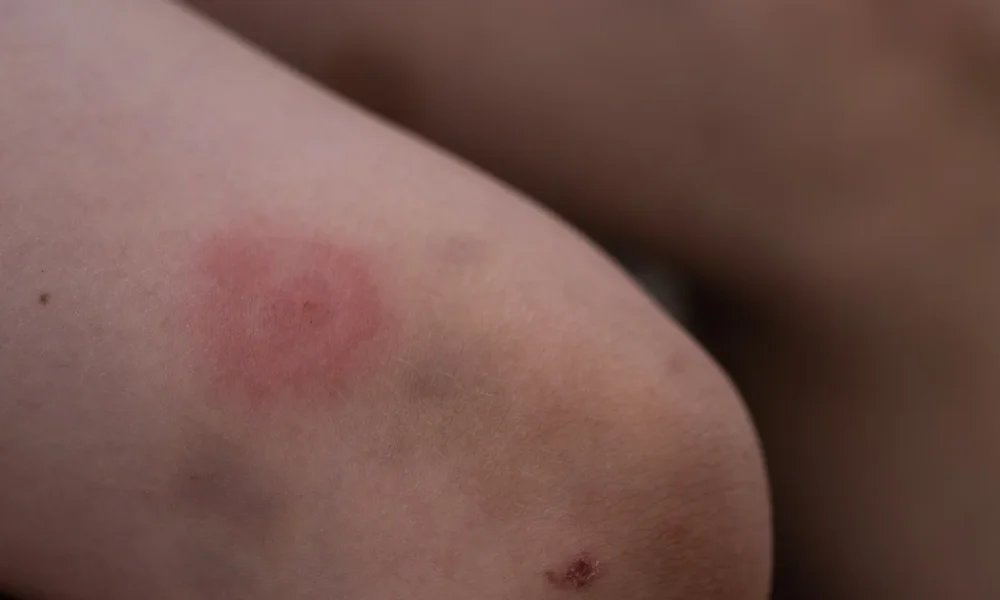 How To Remove A Tick And Symptoms To Watch For After A Bite