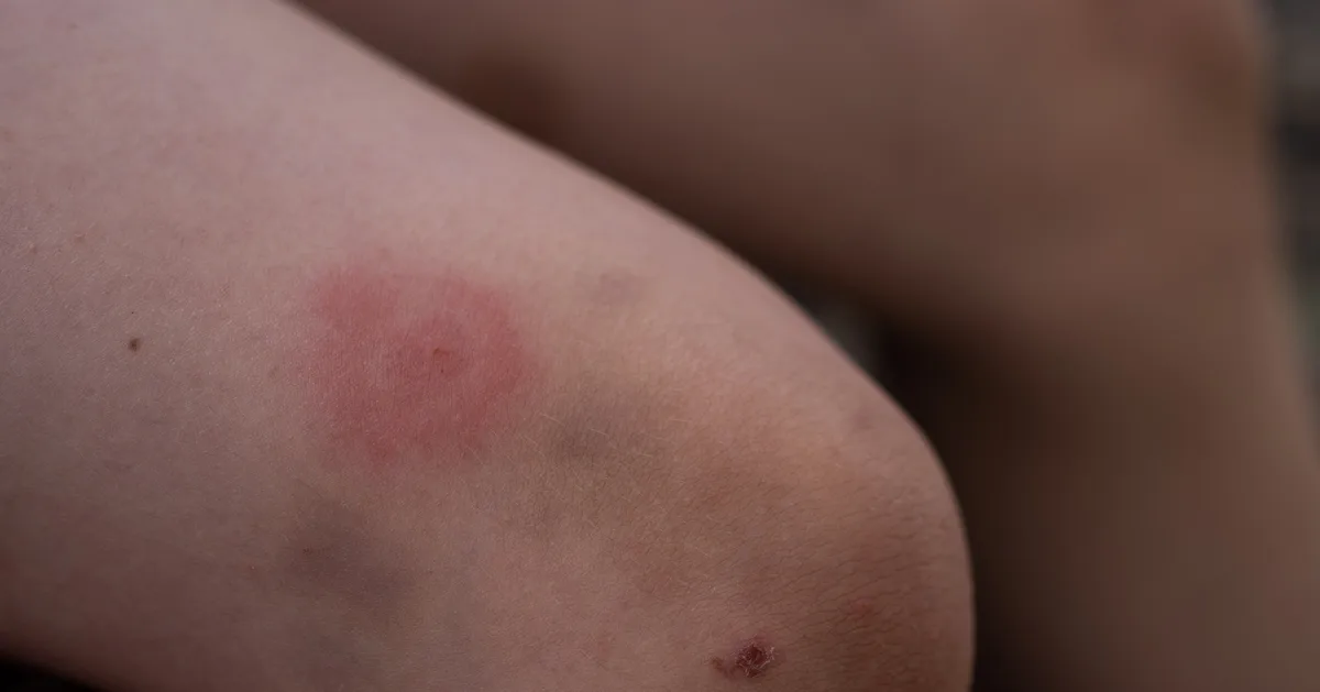 How To Remove A Tick And Symptoms To Watch For After A Bite