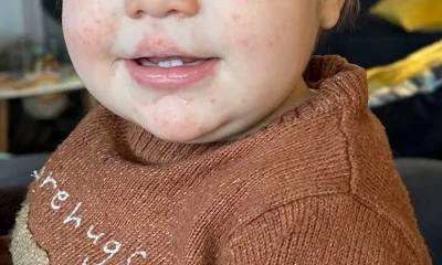 Chickenpox, Impetigo Or Hand, Foot And Mouth: How To Spot Difference