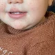 Chickenpox, Impetigo Or Hand, Foot And Mouth: How To Spot Difference