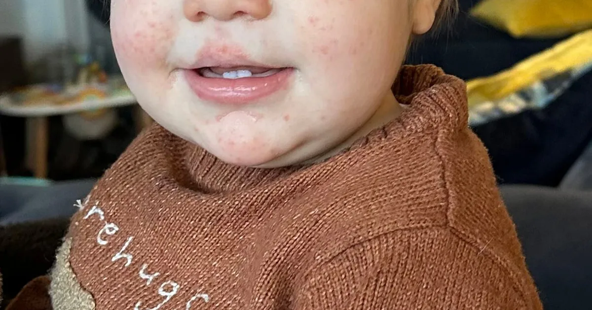 Chickenpox, Impetigo Or Hand, Foot And Mouth: How To Spot Difference