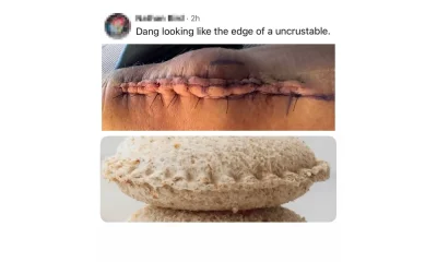 Logan Paul Posts Grotesque Photos After Tricep Surgery 2