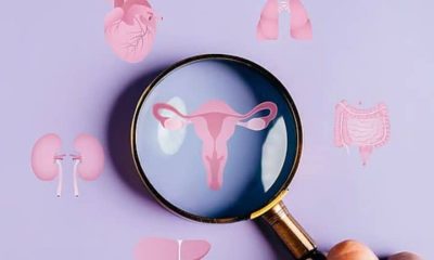 PCOS