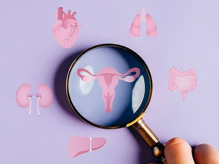 PCOS