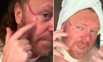 Leigh Francis reveals horrifyingly huge gash on face caused by fan's fingernail