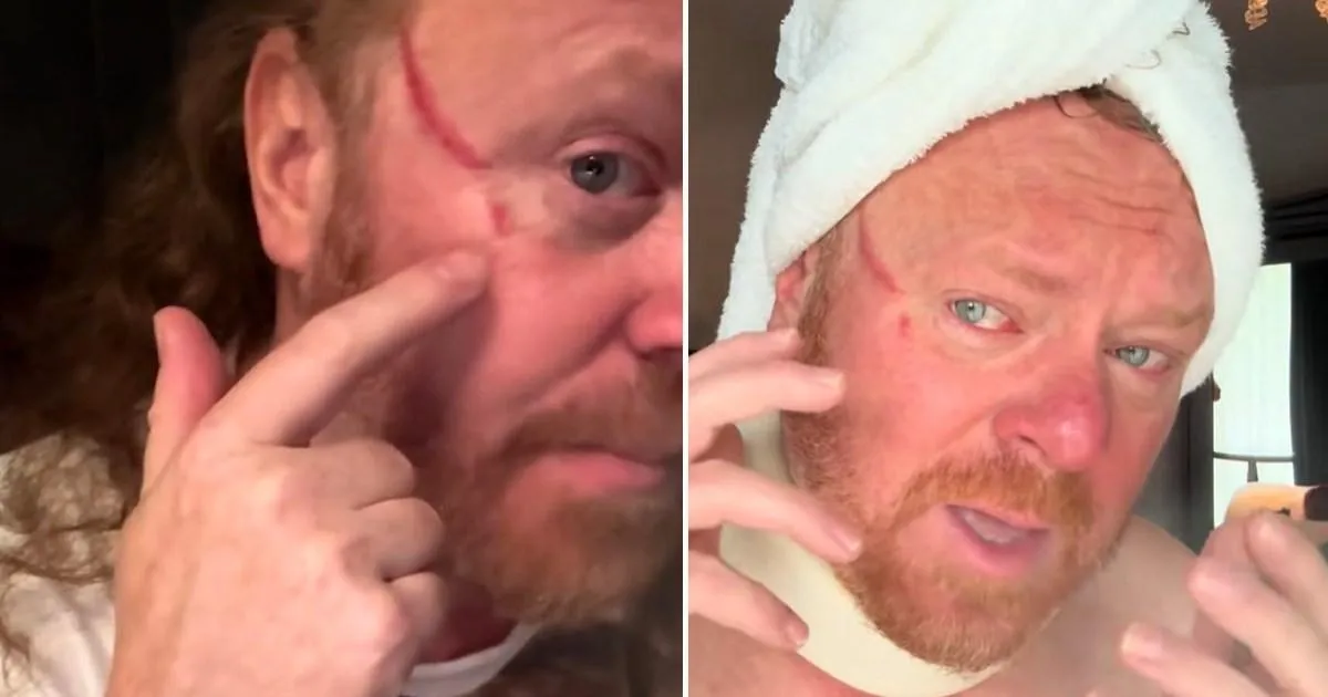 Leigh Francis reveals horrifyingly huge gash on face caused by fan's fingernail