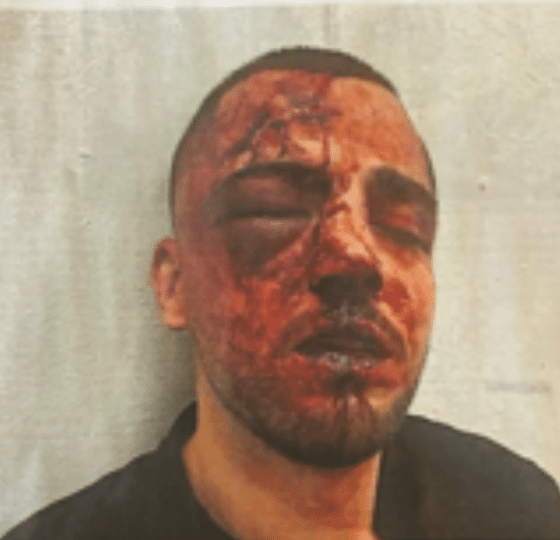 Saleh Khalil Faisal Na’ama in Israel. His face is red with darkened blood and his right eye swollen shut