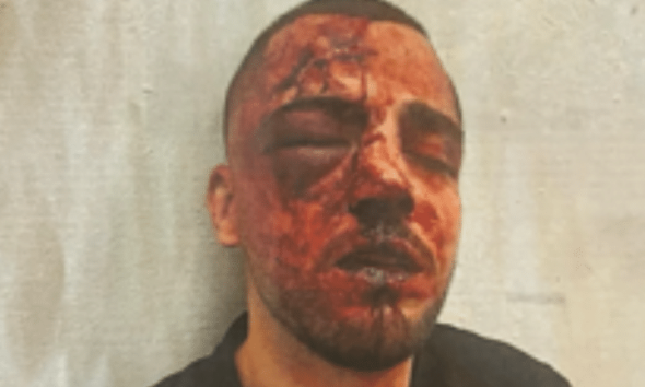 Saleh Khalil Faisal Na’ama in Israel. His face is red with darkened blood and his right eye swollen shut