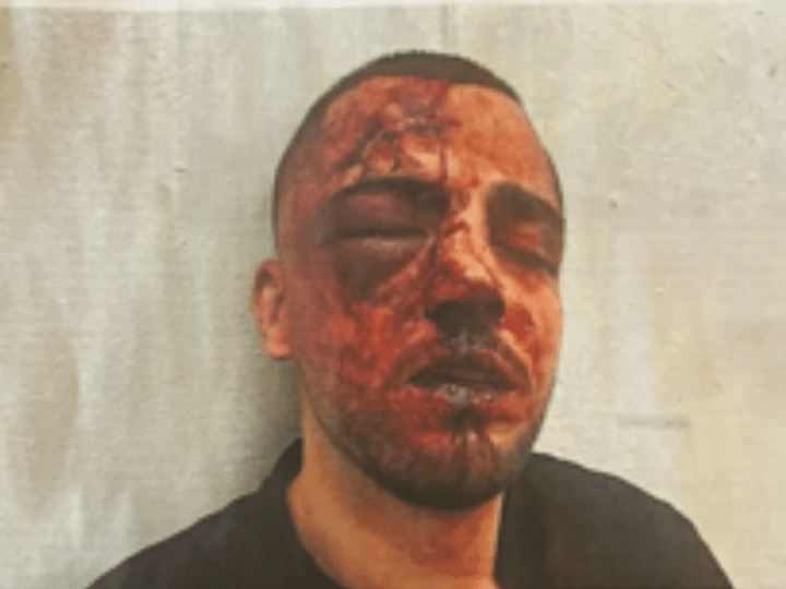 Saleh Khalil Faisal Na’ama in Israel. His face is red with darkened blood and his right eye swollen shut