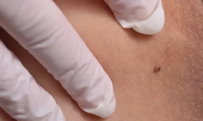 How To Tell If A Mole Is Skin Cancer Using The ABCDE Method