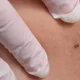 How To Tell If A Mole Is Skin Cancer Using The ABCDE Method