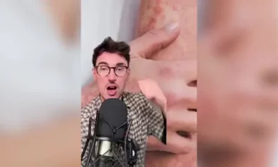 I have psoriasis and scientists THINK they might've found the cause