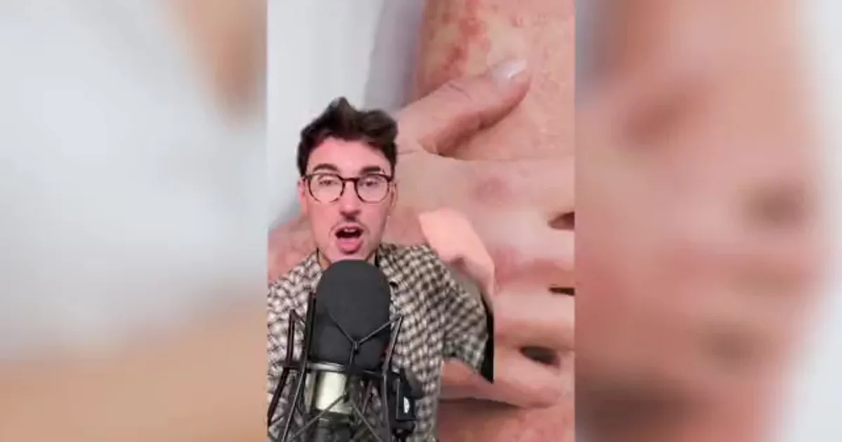 I have psoriasis and scientists THINK they might've found the cause
