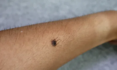 Why Are Mole Hairs Are So Thick And Dark?