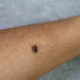 Why Are Mole Hairs Are So Thick And Dark?