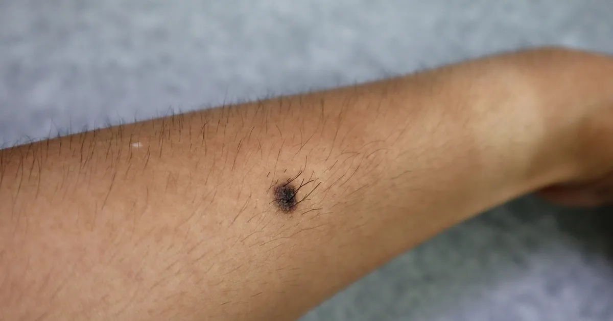Why Are Mole Hairs Are So Thick And Dark?
