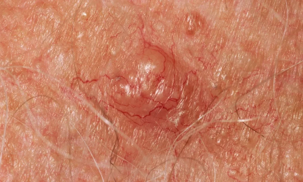 Skin Changes That Could Be A Sign Of Cancer