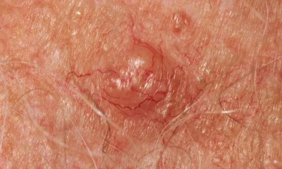 Skin Changes That Could Be A Sign Of Cancer