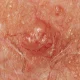 Skin Changes That Could Be A Sign Of Cancer