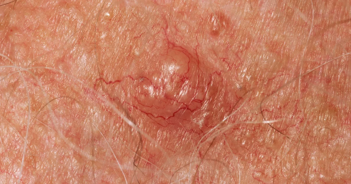 Skin Changes That Could Be A Sign Of Cancer