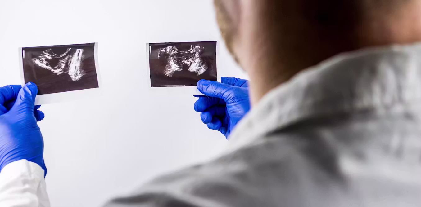 Why some men with prostate cancer may soon need only five radiotherapy sessions