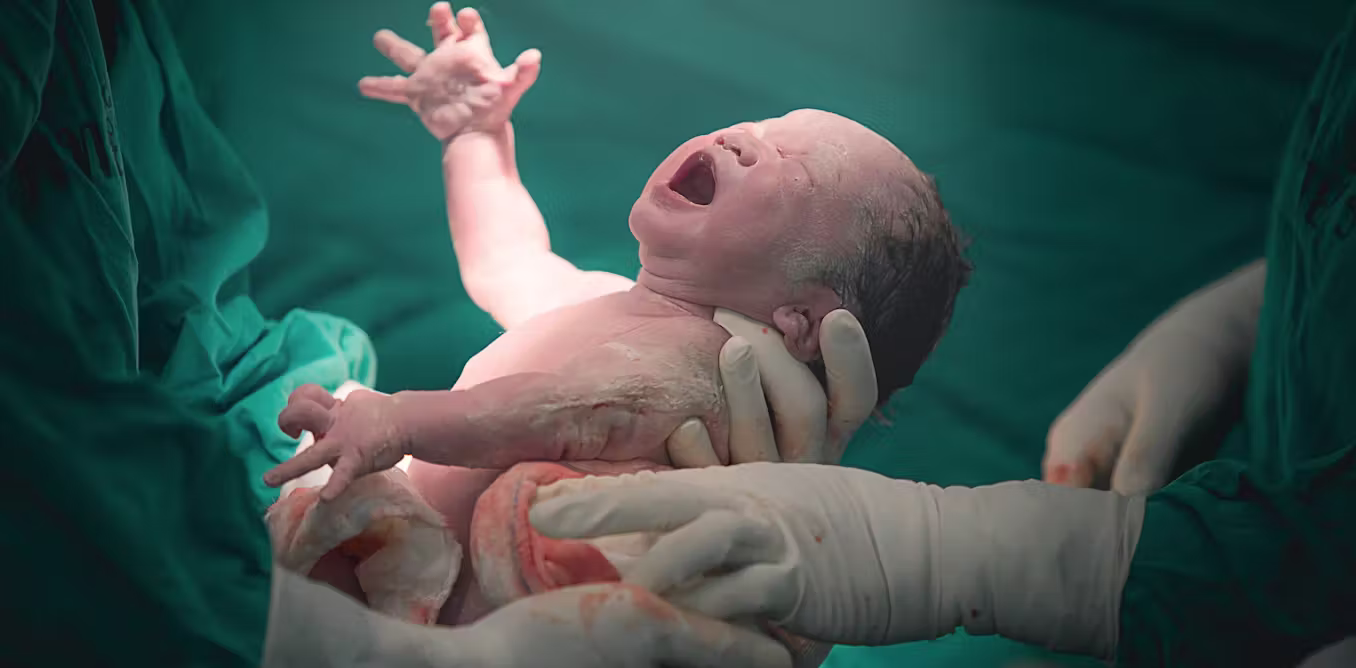 Why more births now end in caesarean section