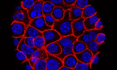 Daraxonrasib vs. pancreatic cancer: Experimental pill helped people live longer