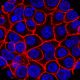 Daraxonrasib vs. pancreatic cancer: Experimental pill helped people live longer