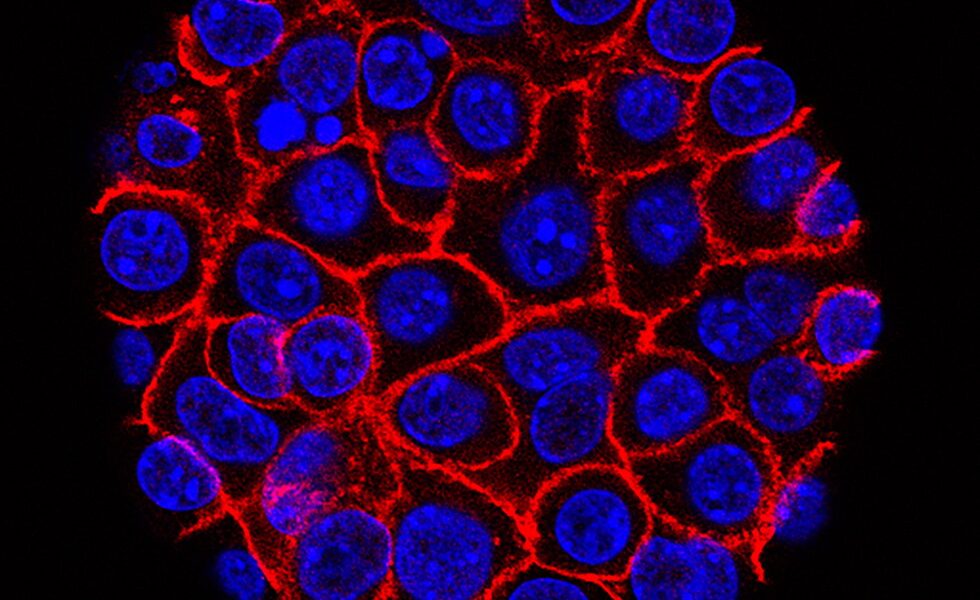 Daraxonrasib vs. pancreatic cancer: Experimental pill helped people live longer