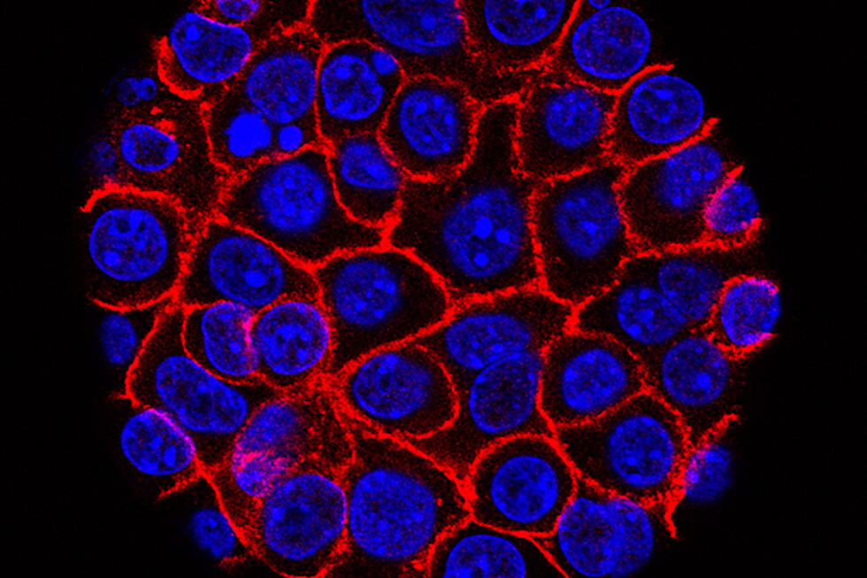 Daraxonrasib vs. pancreatic cancer: Experimental pill helped people live longer