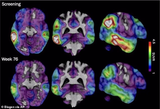 Alzheimer's Disease is the most common form of dementia