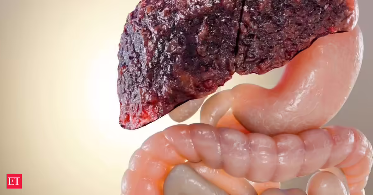 Fatty liver new treatment found: Study discovers a medicine that reverses severe fatty liver by just repairing the gut