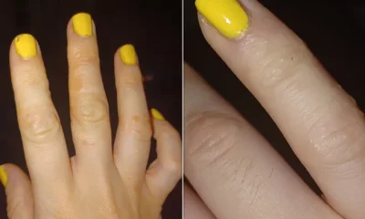 Disyhdrotic eczema